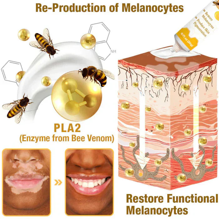 Bee Venom VitiGO Correcting Cream - Buy 1 Get 1 FREEš„š„