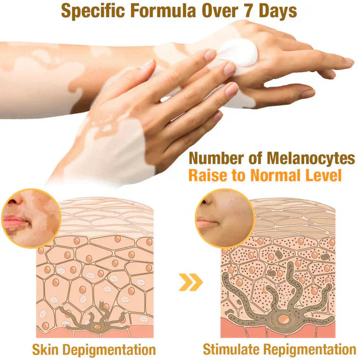 Bee Venom VitiGO Correcting Cream - Buy 1 Get 1 FREEš„š„