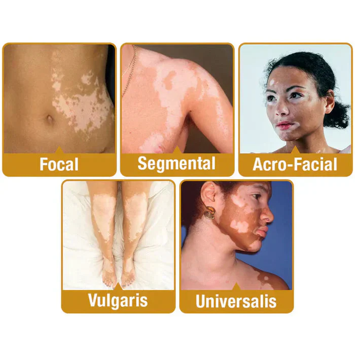 Bee Venom VitiGO Correcting Cream - Buy 1 Get 1 FREEš„š„